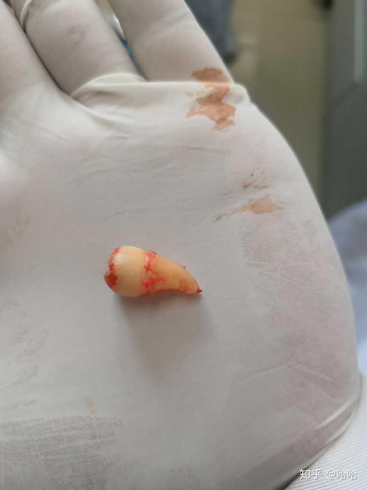 拔智齿有多痛?