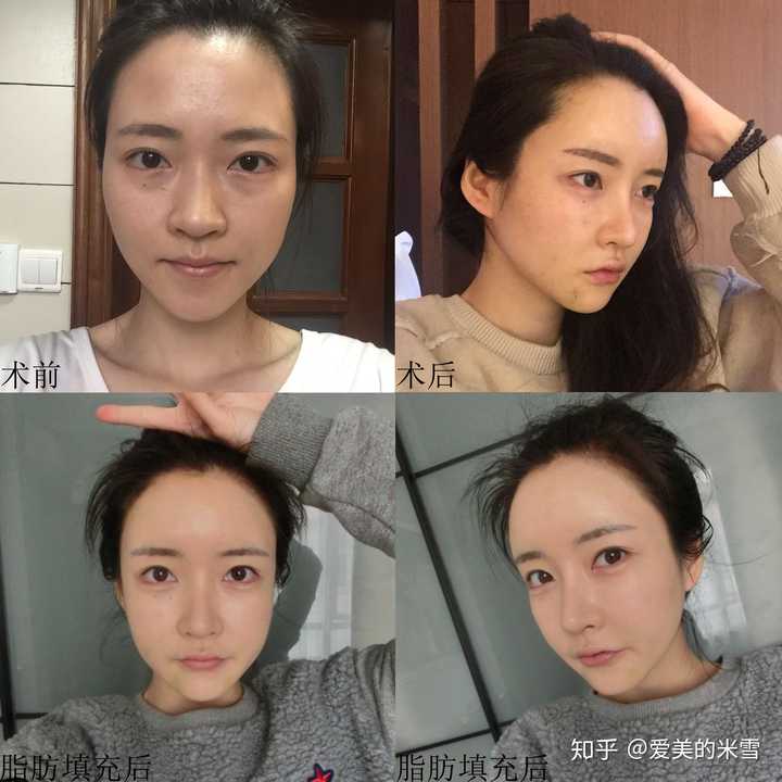 颧骨内推是怎样一种手术?