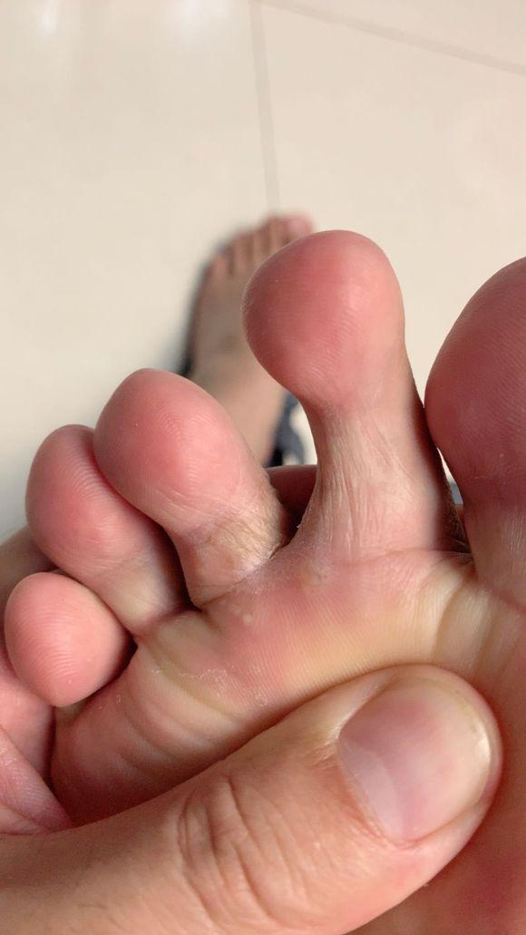 脚气有什么症状,有什么治疗的好方法吗?