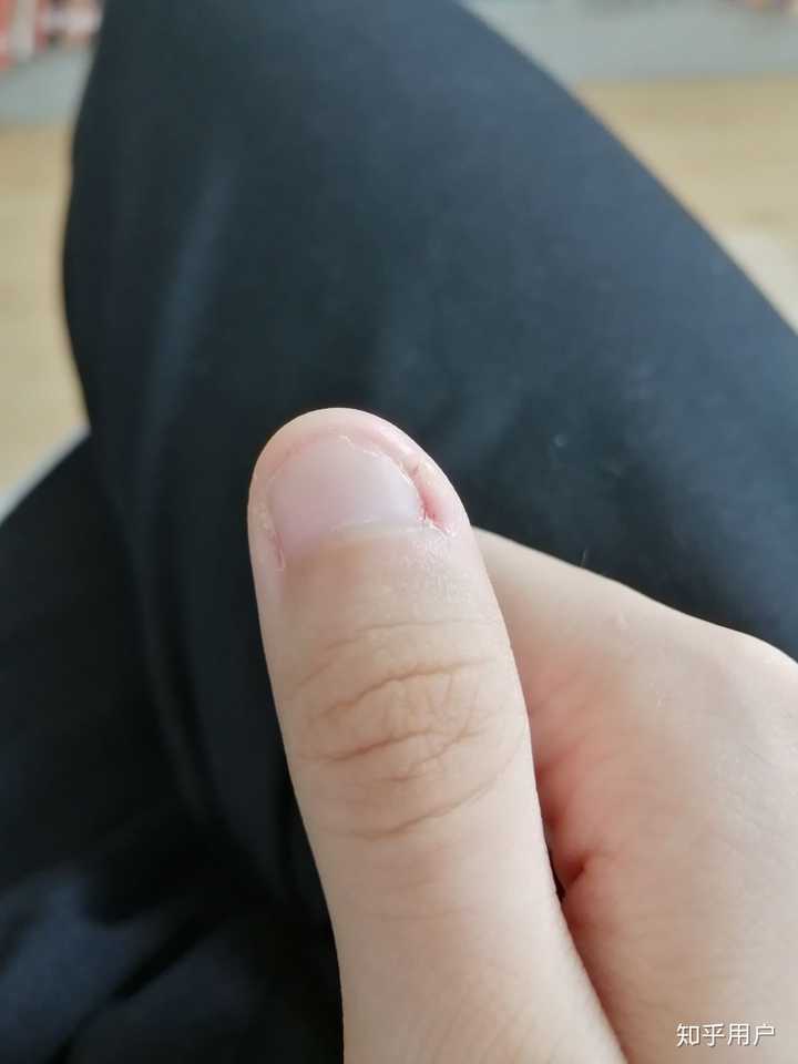 甲床过短应该如何变长?