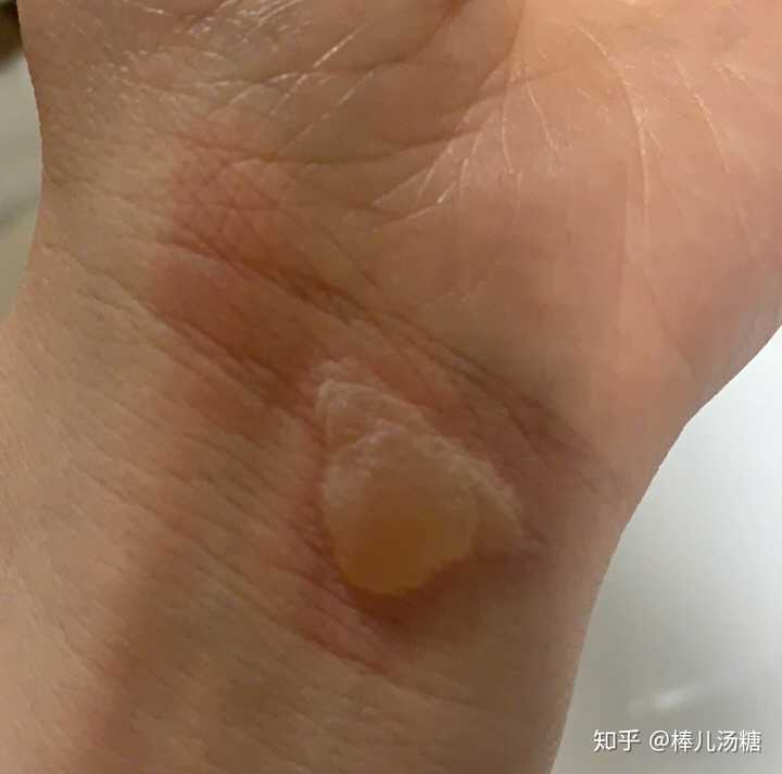 手烫伤了怎么办,起泡了?