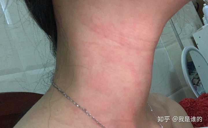 得了荨麻疹是一种怎样的体验?