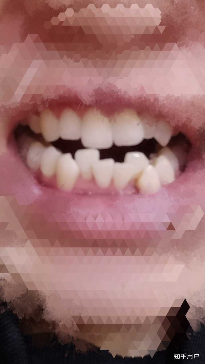 什么时候意识到自己牙不齐的呢,大概初三的时候?