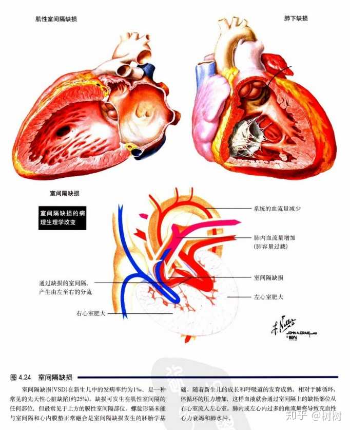 先天性心脏病室间隔缺损术后可以剧烈运动吗?可以上体育课吗?