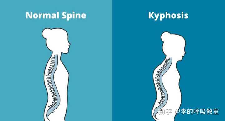 驼背和脊柱侧弯的区别在哪儿?纠正方法有什么不一样吗