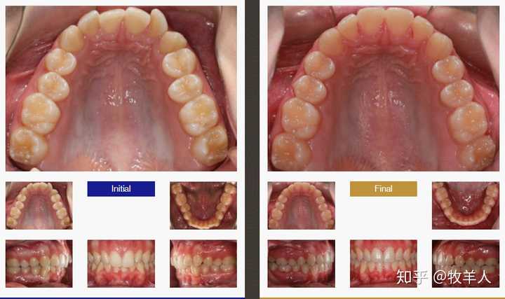 当牙齿出现只有后牙可以接触,前牙开颌,例如连咬断面条都做不到时.