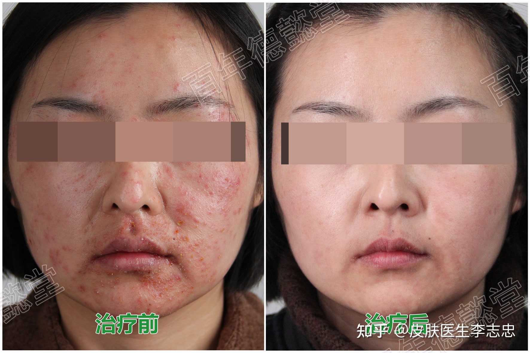 皮肤医生李志忠