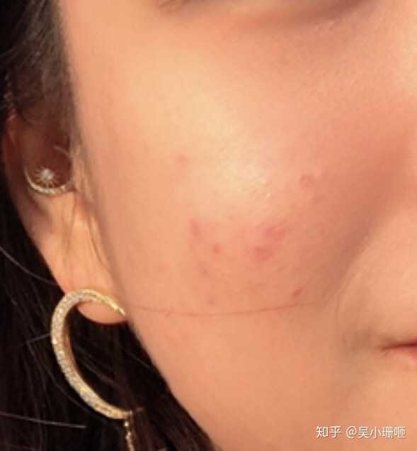 我属于轻度痤疮,长痘痘时真是一波未平 一波又起啊 我的方法不适用于