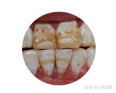 常见于乳牙根尖周组织发生严重感染,影响了其下方继承恒牙牙胚的釉质