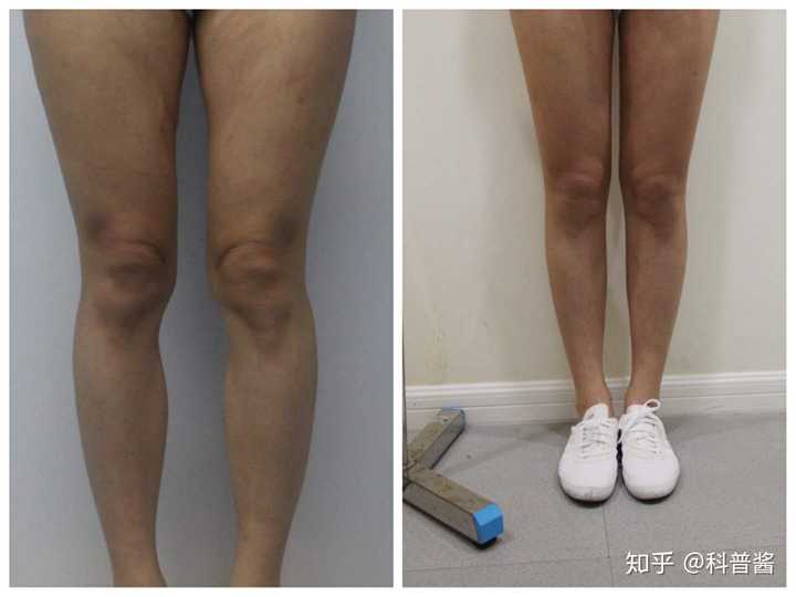 通过脂肪填充改善xo型腿