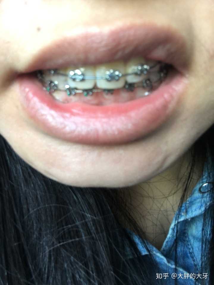 下牙比较小,托槽密密麻麻的,感觉不如上牙那么舒服.