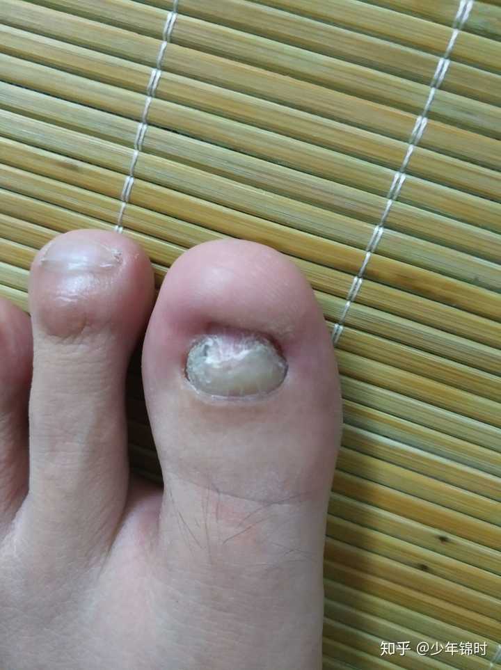 我就是这样子的 我8年前做的手术,就是拔甲 烧毁甲床 费用也不贵,小