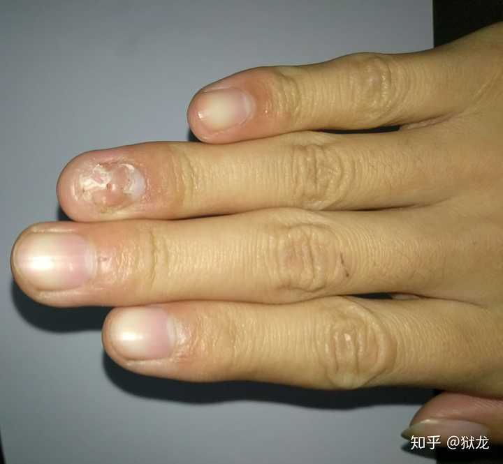 手指甲被夹到,过了一段时间,有黑色的淤血,怎么处理?