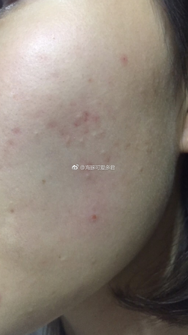 开放性粉刺亦称黑头或黑头粉刺,是由于皮脂毛囊口扩大,角质碎屑,毛发