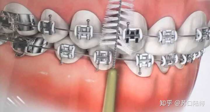牙线:牙套君清洁牙齿的另一利器.第一步,把它从弓丝底下穿过