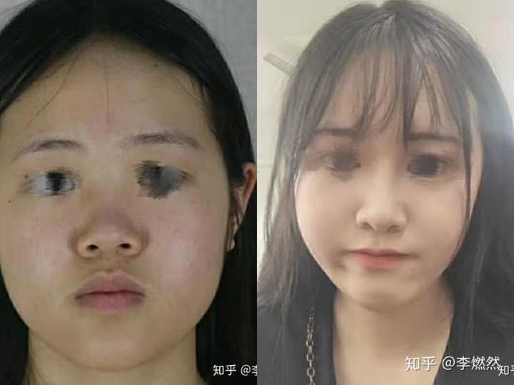 塌鼻子一定要做隆鼻吗?