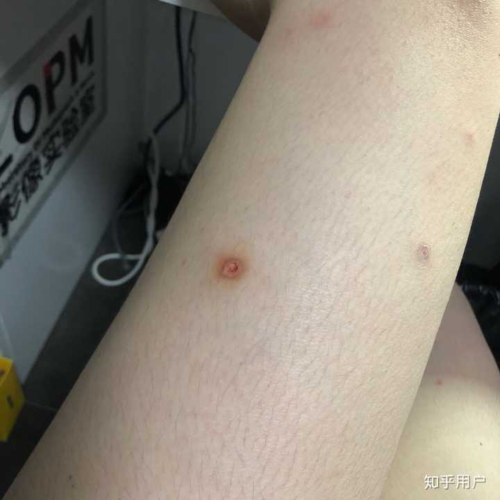 刚开始几天只是这样的红点 去医院看了之后,确认为水痘 拿了药赶紧