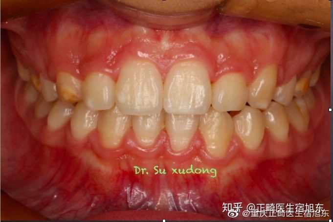 牙龈有正常的形态 颜色:粉红 形状:菲薄无肿胀 质地:坚韧有弹性