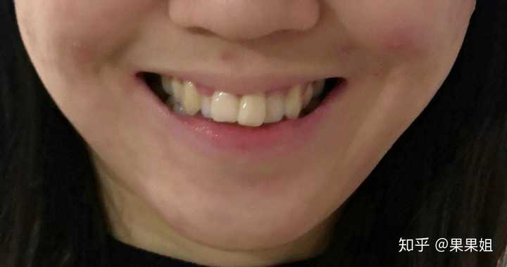 长的好看但是牙齿丑是什么体验?