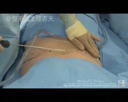 吸脂有哪些危害和后遗症?