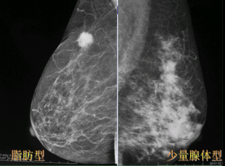 多量腺体型和致密型乳房x光照片