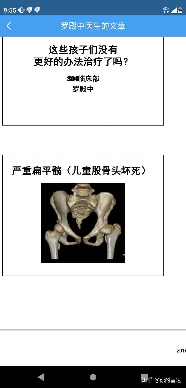 髋关节骨软骨病,少年型股骨头骨软骨炎及扁平髋