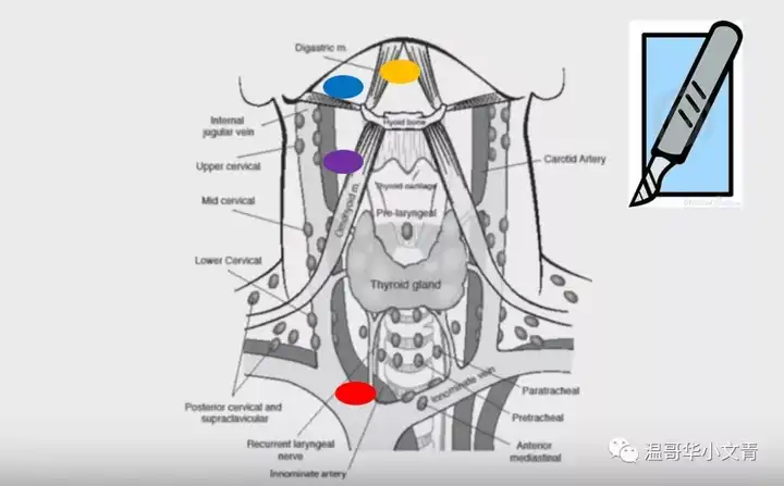 中央区 侧颈区 特殊位置的淋巴结清扫
