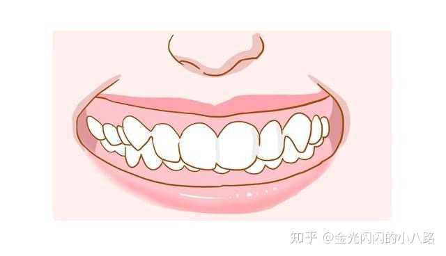 具体的程度,你看牙齿咬合后你的下牙齿是在上牙齿的什么部位,越靠近上