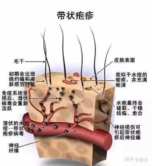 带状疱疹的诱因是什么?如何有效治疗?