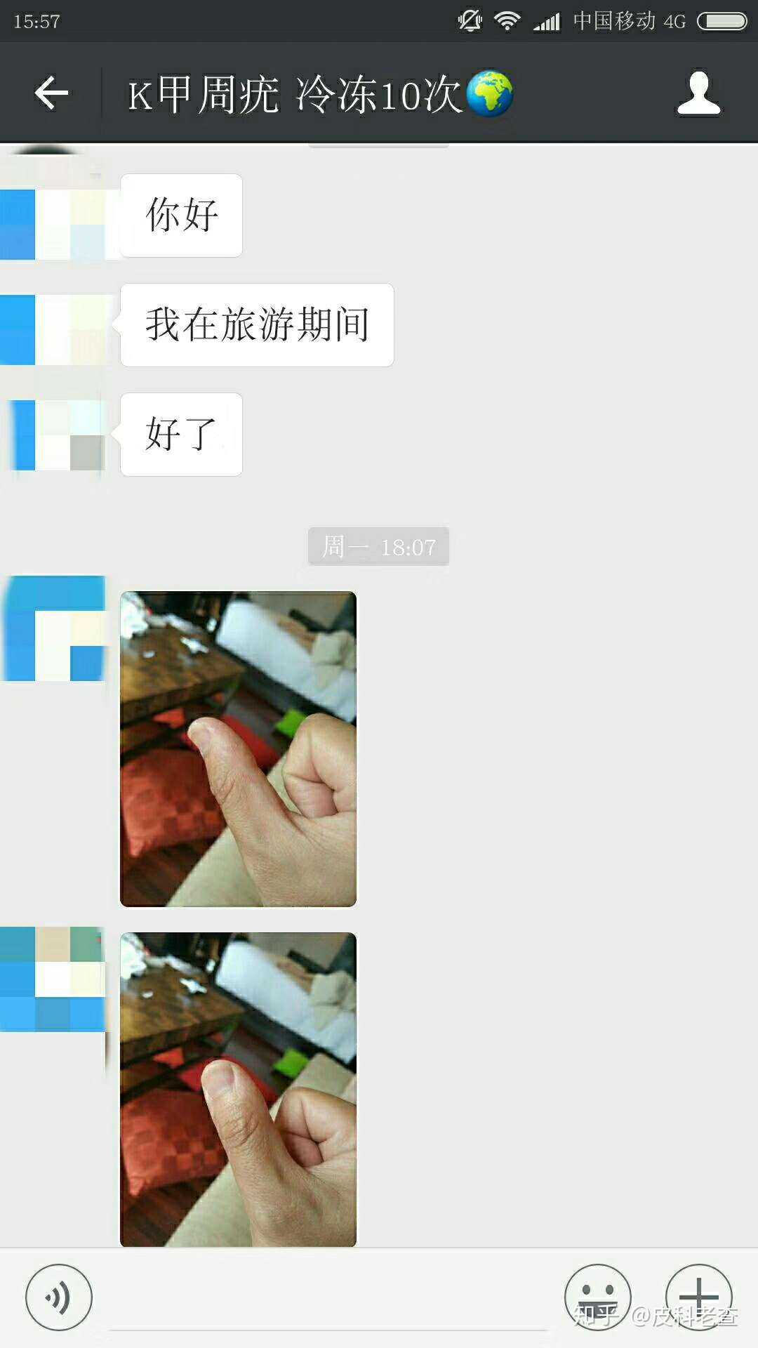 冷冻过10次的甲周疣患者,接近痊愈啦,继续努力