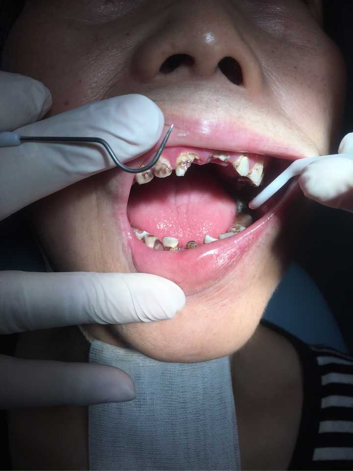 牙医碰见最烂的牙有多烂?