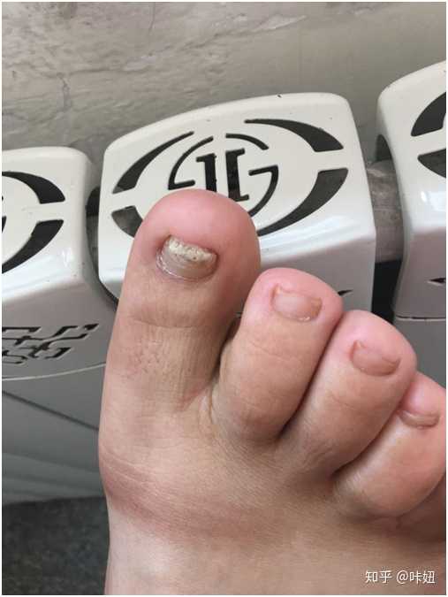 脚趾甲很厚 是灰指甲吗?