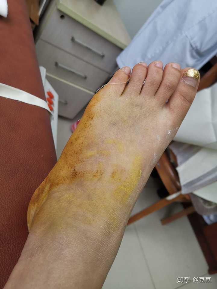 左脚第五跖骨骨折?