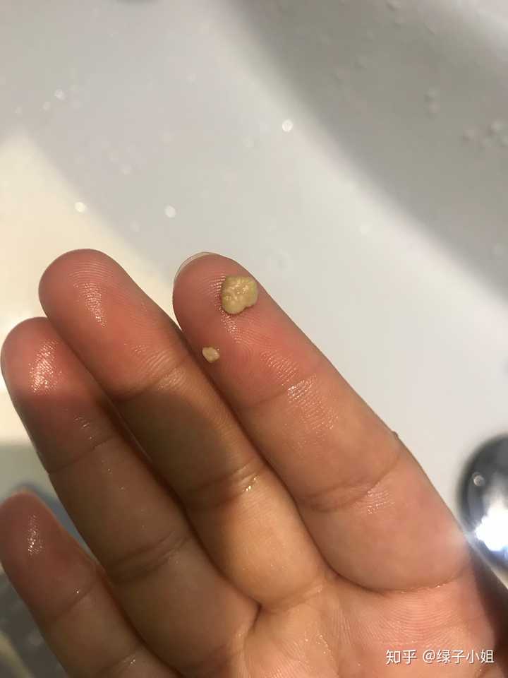 喉咙里偶尔会吐出很臭的小颗粒,医生说是扁桃体结石,做了扁桃体摘除