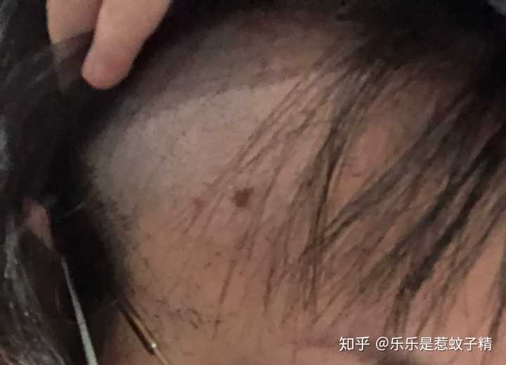 上一颗黑痣,在我近五年的百度中,心里已经把它默认为基地细胞癌了如图