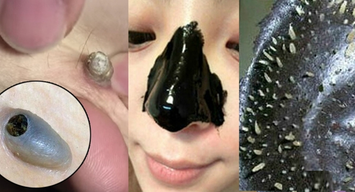 该怎样有效去除黑头?