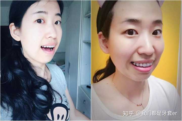 嘴咬合的时候会咬到牙套,所以把两颗牙齿垫高了.