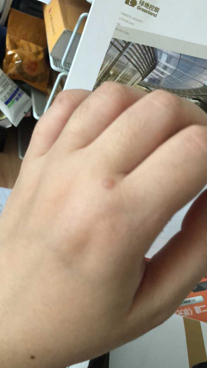 tmd ……我终于有了一个高中时期不良少年身上的烟疤 下图是起泡的