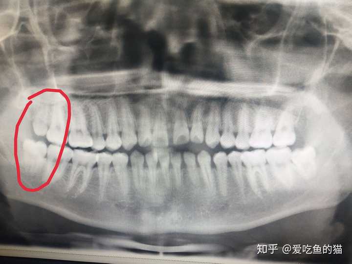 看到片子感觉自己的智齿长得还行,但是谁能告诉我为什么还是要那么贵