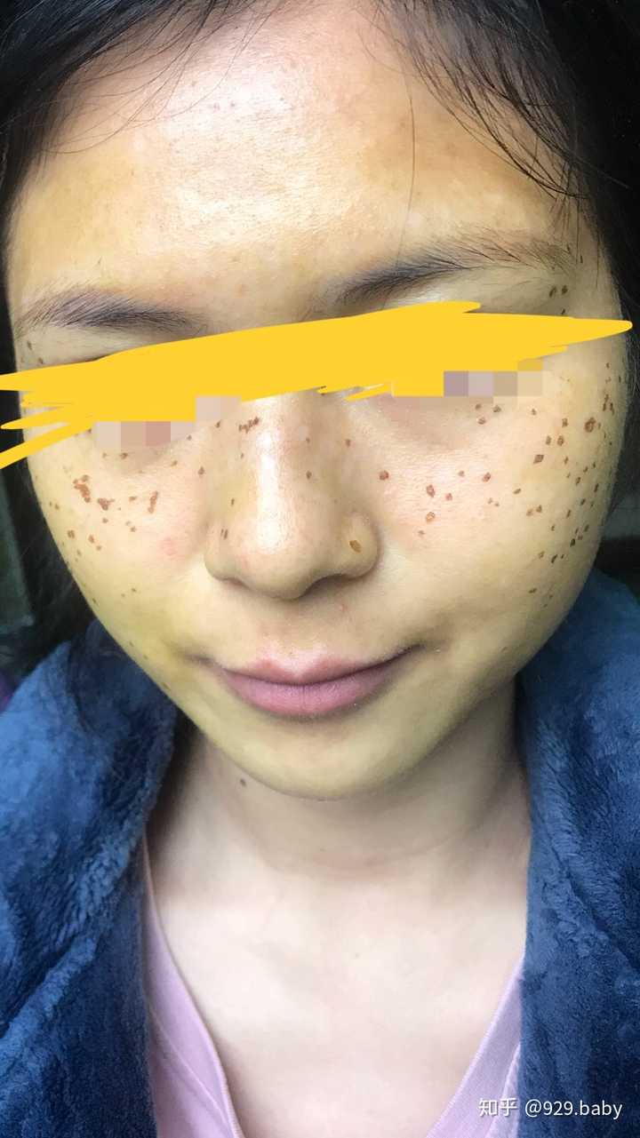 关于美容院的那种药水点痣点斑 有人说有效 有人说点了还不如以前 谁
