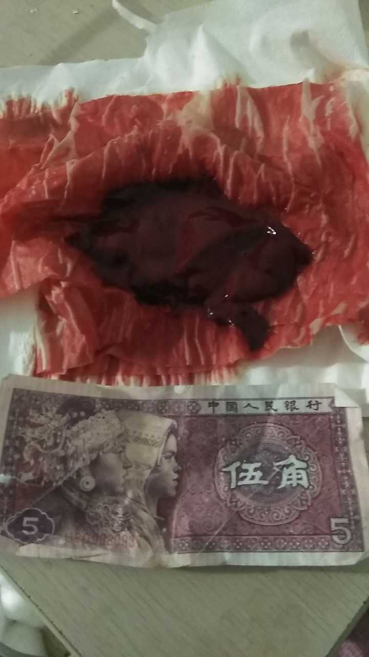 用梅花针拔气罐法从血液中出来的果冻状的东西是什么?