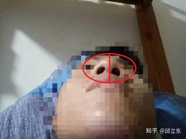 鼻中隔的问题需要到医院拍 三维立体重建.