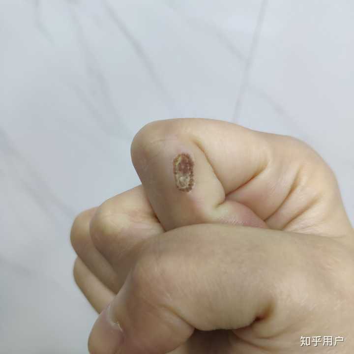一共长了两个寻常疣,都是表皮看过去直径应该在一厘米左右,也都是