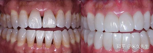 牙周膜,牙周骨改建过程中,牙齿松动度增加,属于正常