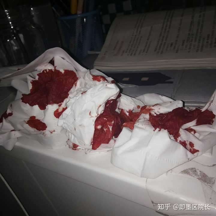 流鼻血了,如果不管它,低下头任它流,会发生什么?