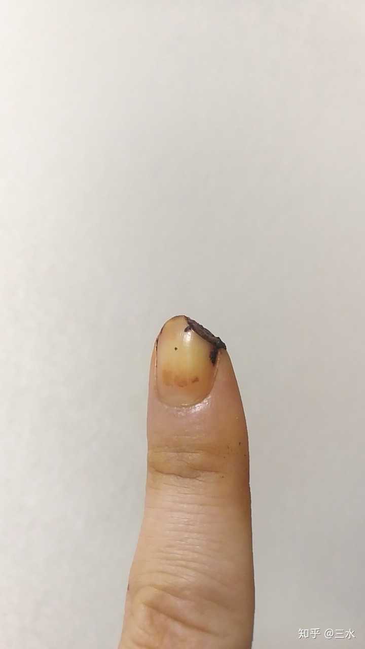手指被割掉一块肉是什么体验