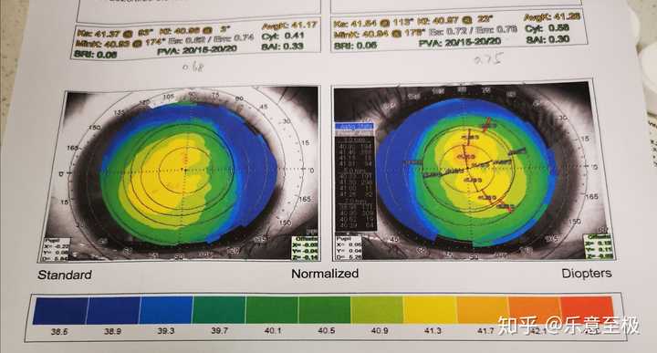 角膜地形图上的黄色就是散光吗