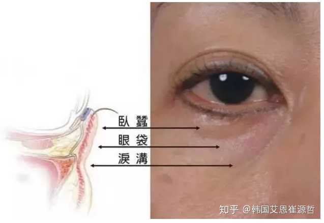 20岁有眼袋泪沟怎么办