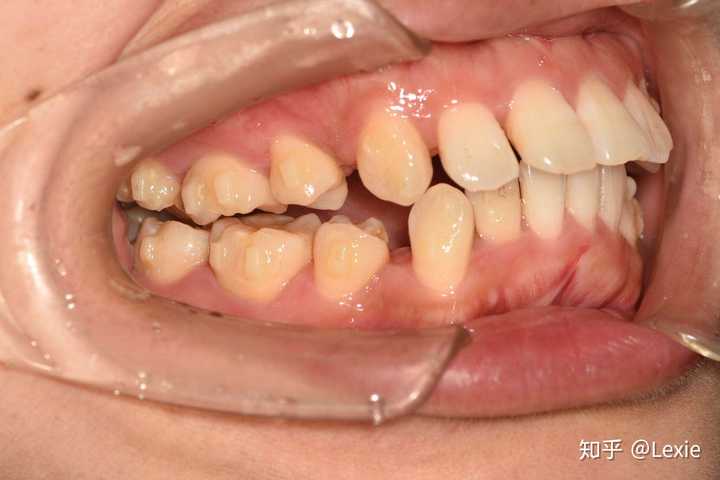 为什么会有牙齿矫正失败的案例?