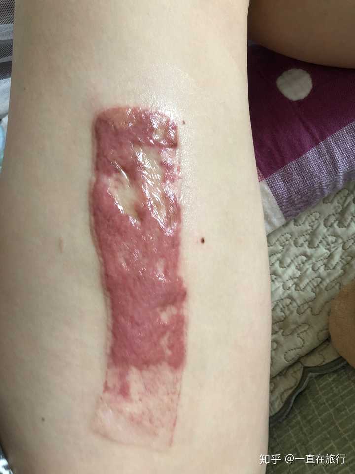 第二张是小腿车祸留的疤痕,植过皮,第三张是大腿取皮处还没有恢复